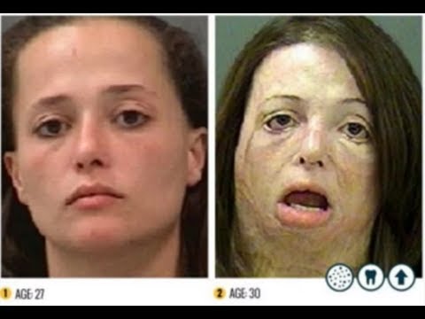 The Shocking Faces of Meth Campaign
