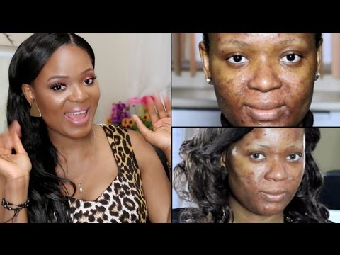 Real Talk | Acne : Depression, Self Pity, Insecurity & Low Self Esteem